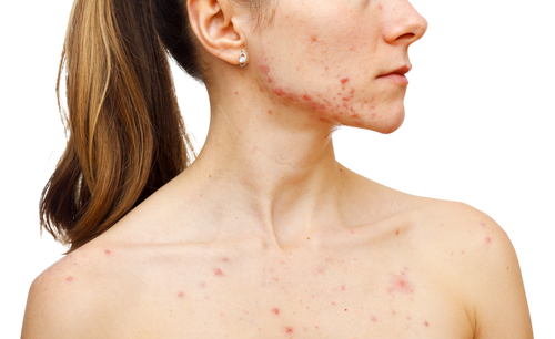 Portrait of woman showing her pimples on isolated white background
