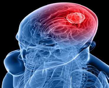 Conozca algunas señales de alerta para detectar a tiempo un derrame cerebral y cómo prevenirlo