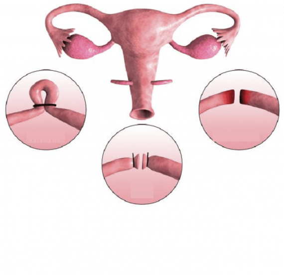 Cosas que nadie te dirá sobre la ligadura de trompas... Dios Es Bueno Cosas que nadie te dirá sobre la ligadura de trompas... Dios Es Bueno